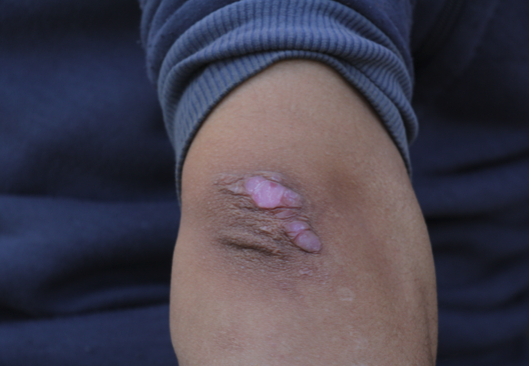 Una de les moltes ferides de l’Amir (fotografia: Oriol Bäbler).