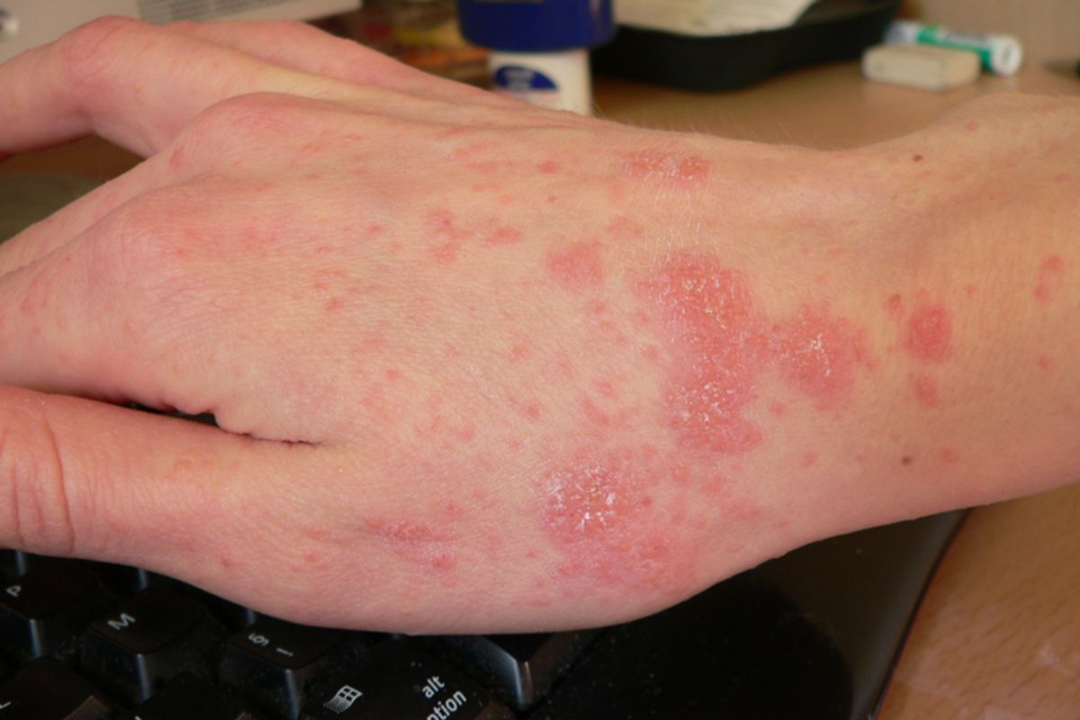 Imatge de la mà d'un malalt de sarna al començament del tractament. Fotografia: Wikimedia Commons