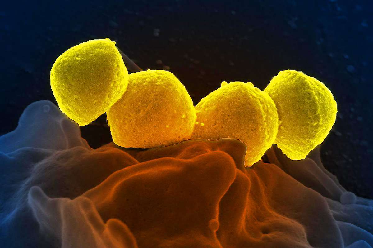Una imatge acolorida digitalment mostra estreptococs del grup A (GAS) sobre la superfície d'un glòbul blanc (fotografia: CDC)
