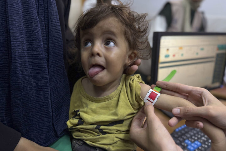 Un infant és tractat per desnutrició a l'Hospital de la Societat Benèfica d'Amics del Pacient de la Ciutat de Gaza, aquesta setmana (fotografia: Ahmad Awad/Efe).