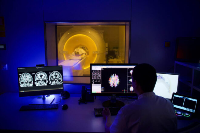 Desenvolupen a Catalunya el primer biomarcador en la sang capaç d’anticipar la progressió a la demència d’Alzheimer