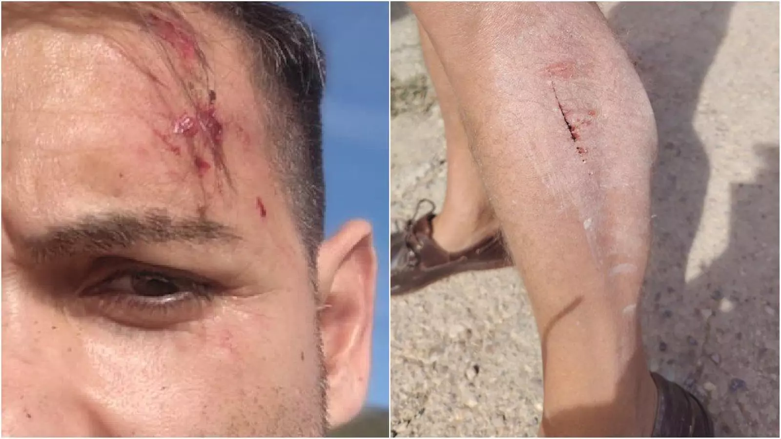 Les ferides que ha rebut l'equip d'À Punt apallissat per uns ramaders (fotografia: À Punt)